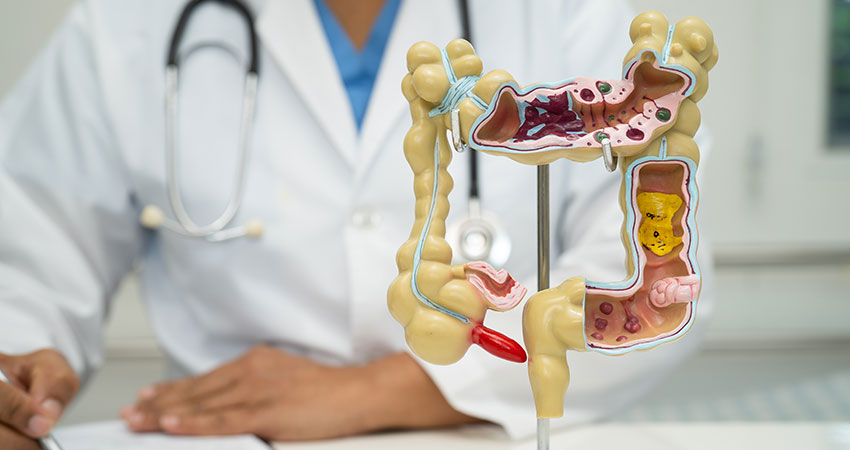 Colon Cancer